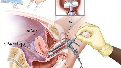 पाठेघरको मुखको क्यान्सर